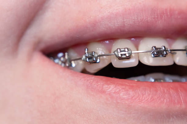 istock Beauty through care: Teeth with braces reflect attention to appearance and health, representing confidence during transformation. 2192066657