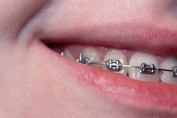 istock A smile in progress: A slightly open mouth reveals teeth with braces, symbolizing the journey toward perfection. 2192066662