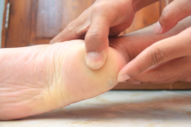 istock Dry and cracked soles of feet 2192074723