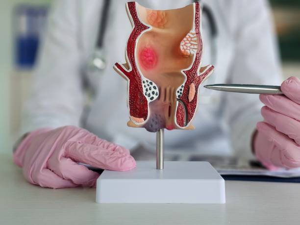 istock Doctor holds pen and rectum model with inflammation concept 2192347034