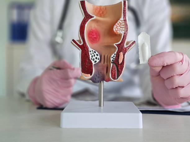 istock Proctologist doctor inserting rectal suppository into artificial model of human rectum concept 2192347102
