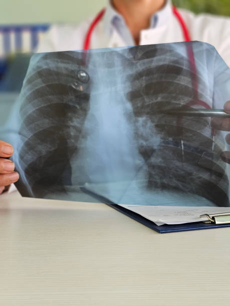 istock Doctor examines chest X-ray to assess lung health and identify potential issues 2192414846
