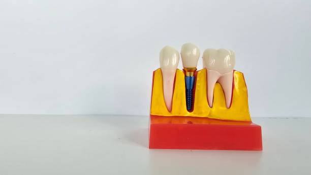 istock Dental model demonstrating implant procedure and tooth structure used for educational purposes in a clinical setting 2192599619