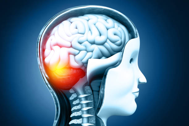 istock Meningitis inflammation on the brain and spinal cord. 3d illustration 2192792692