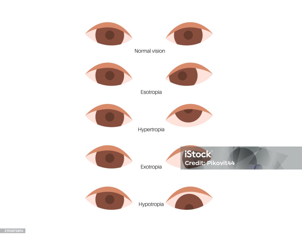 Strabismus Vision Example Strabismus Eye Disease Stock Illustration - Download Image Now ...