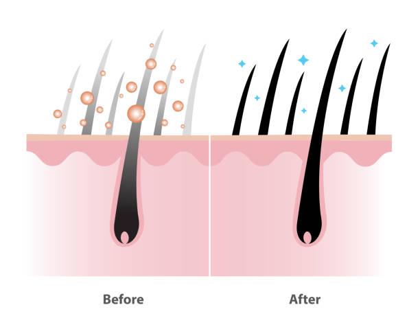 istock Before and after the mechanism of gray hair coverage shampoo with scalp layer vector illustration isolated on white background. 2192925035