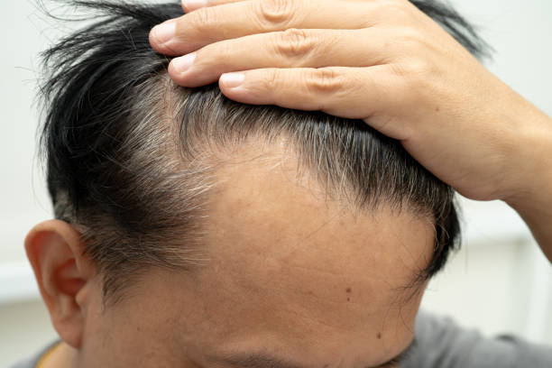 istock Bald head in man, hair loss treatment health problem. 2192971721