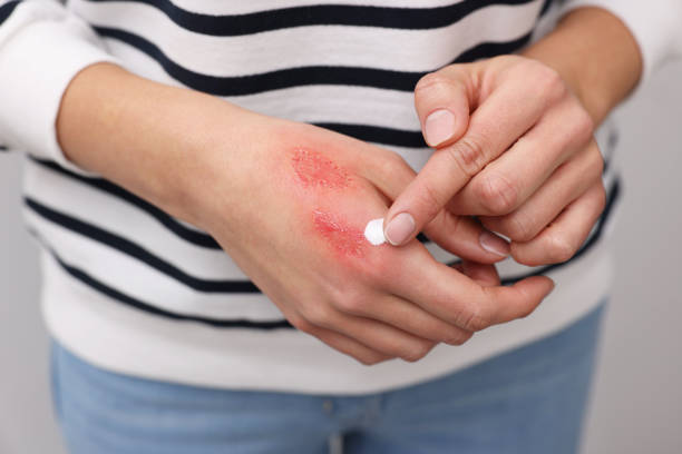 istock Woman applying healing cream onto burned hand, closeup 2193065516