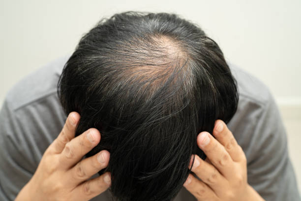 istock Bald head in man, hair loss treatment health problem. 2193194741
