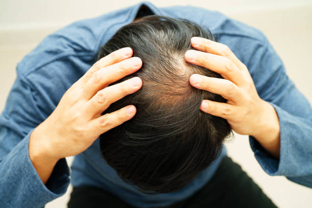 istock Bald head in man, hair loss treatment health problem. 2193200839