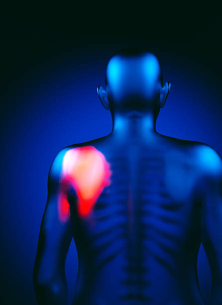 Medical visualization of shoulder pain or injury. The highlighted red area likely indicates the site of discomfort or inflammation, with the surrounding blue representing unaffected regions.