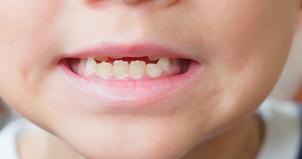 istock Child cavities and crooked teeth 2193569311