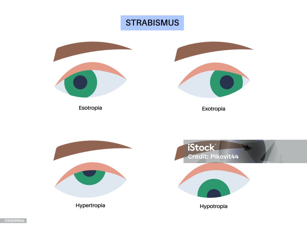 Hypertopic Strabismus Strabismus Eye Disease Stock Illustration - Download Image Now ...
