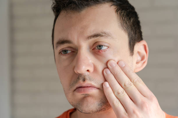 istock Man with infected chalazion (stye, barley) eye on lower eyelid 2193725196