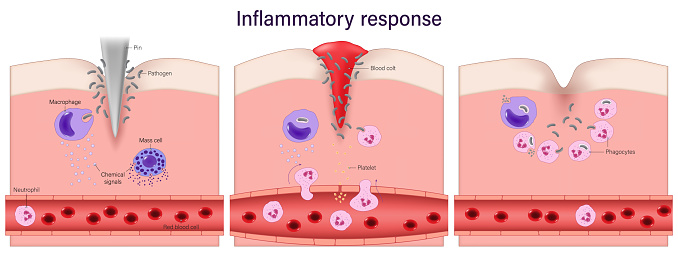 Systemic Inflammatory Process Inflammatory Response Process Of Inflammation Phagocytosis Blood ...