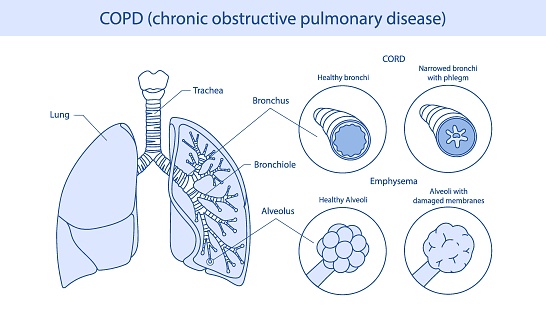 Copd Examples Copd Infographic Manifests Itself In Two Forms Emphysema And Bronchitis ...