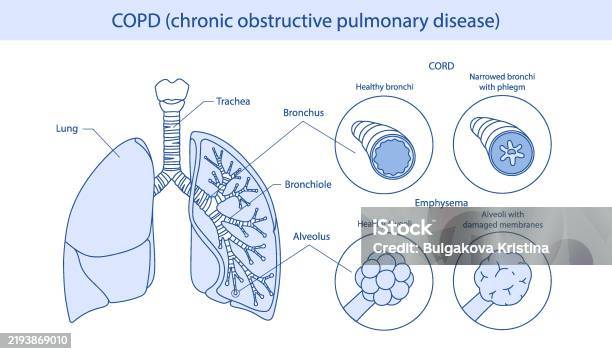 Examples Of Copd Copd Infographic Manifests Itself In Two Forms Emphysema And Bronchitis ...