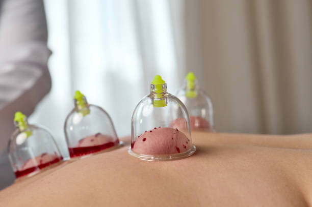 istock Doctor performing cupping therapy on patient's back 2194010345