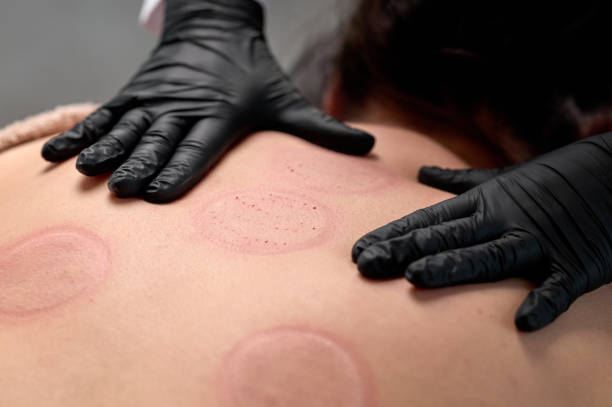 istock Beautician performing cupping therapy on patient's back 2194010358