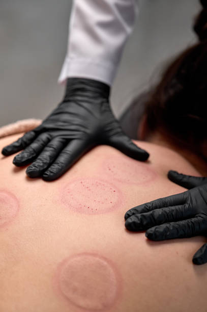 istock Beautician performing cupping therapy on patient's back 2194010369
