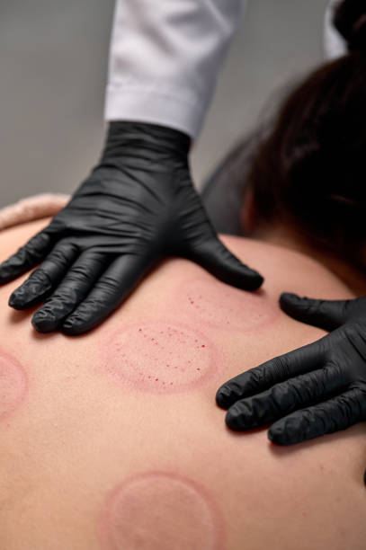 Beautician performing cupping therapy on patient's back