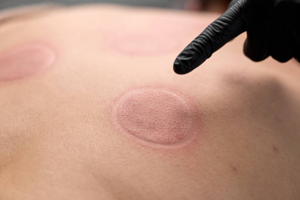 istock Doctor applying cupping therapy on patient's back for pain relief 2194010657