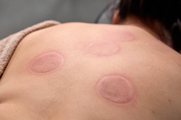istock Patient undergoing cupping therapy on back for pain relief 2194010661