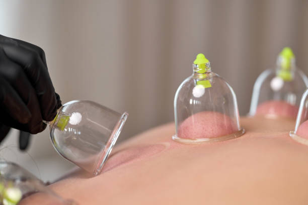 Patient receiving cupping therapy on stomach for pain relief Close-up of suction cups placed on a patient's stomach during cupping therapy cupping therapy stock pictures, royalty-free photos & images