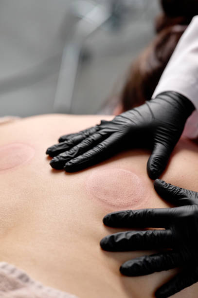 istock Beautician performing cupping therapy on patient's back 2194010665
