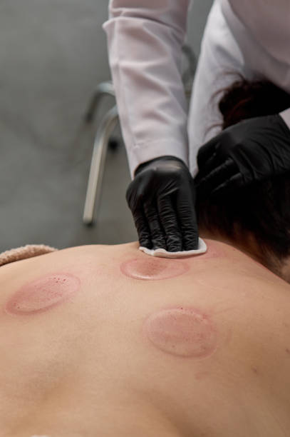 istock Beautician performing cupping therapy on patient's back 2194010811