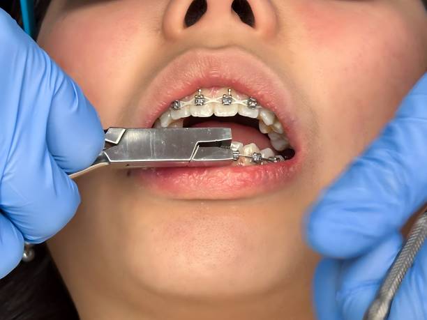 istock Orthodontist treatment installing braces system on a teen. 2194299552