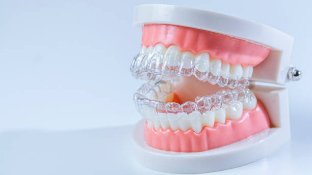 istock Invisible dental teeth brackets teeth aligners on blue background. Plastic braces dentistry retainers to straighten teeth on a white background 2194348106