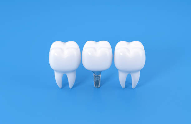 istock Dental Implant And Human Teeth On Blue Background 2194378728