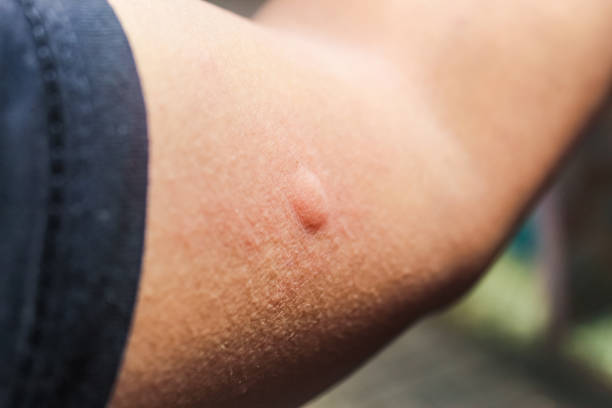 istock allergic skin bumps on hand 2194458818