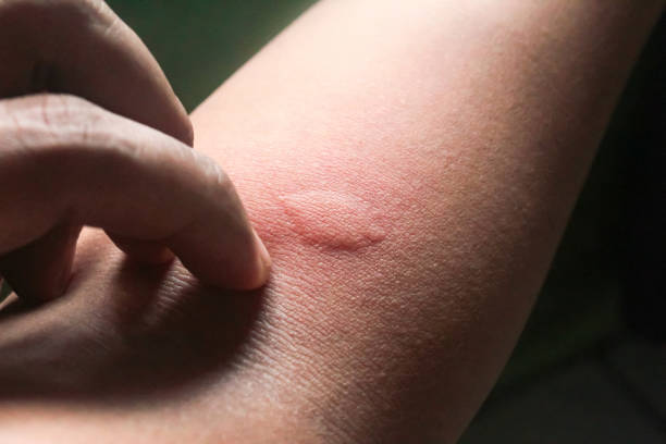istock allergic skin bumps on hand 2194483061
