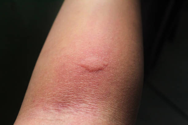 Mosquito feasting on human blood from hand, close-up of a common pest action