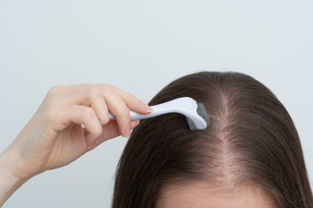istock Close up view of young woman using microneedling derma roller on head for stimulating new hair growth with copy space. Alopecia treatment, scalp stimulation, hair loss and baldness targeted therapy. 2194779671