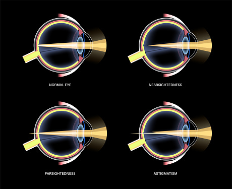 Refractive Error Simulation Refractive Errors Poster Stock Illustration - Download Image Now ...