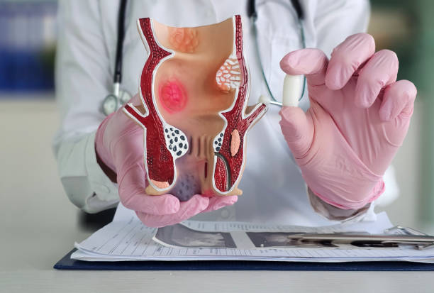istock Proctologist doctor holds rectal suppository and artificial model of human rectum concept 2194817812