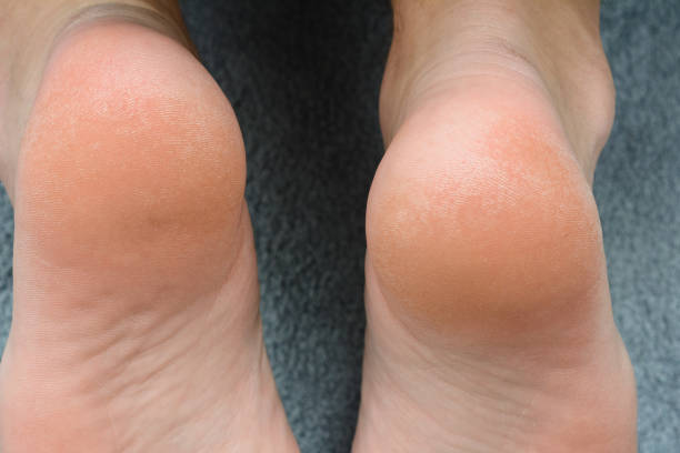 istock Close-up of dry heels on a textured surface. 2194870756