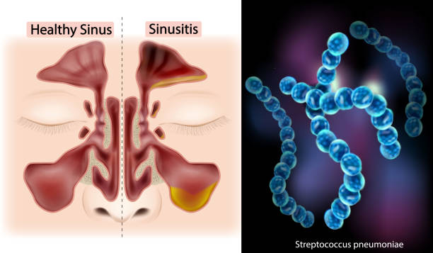 istock Comparison of Healthy Sinus and Sinusitis with Streptococcus Pneumoniae. Sinus Bacterial Infection Concept. Sinus Anatomy and Sinusitis 2194896070