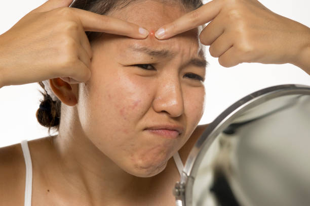 istock Young asian woman Squeezing pimple. 2195136188