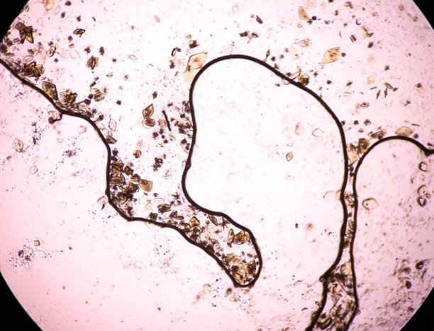 Number of Uric acid crystals monohydrate under microscope.