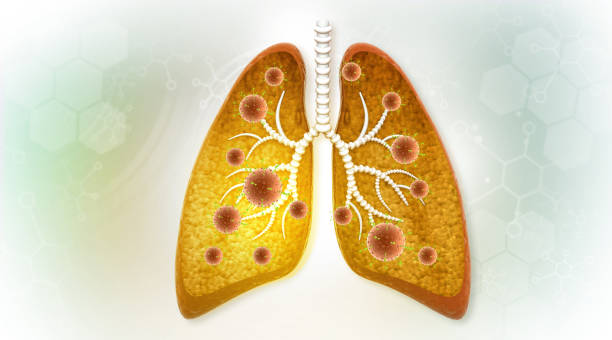 istock Virus bacteria infection in human lungs 2195420487