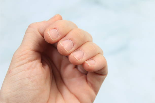 istock Bad skincare and dry cuticles on a woman's left hand 2195439366
