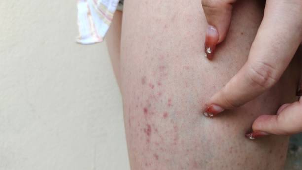 istock The rash hives and urticaria on the leg. 2195449045