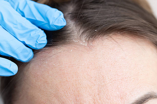 istock An appointment with a dermatologist. Woman has dermatitis on her scalp. 2195481447