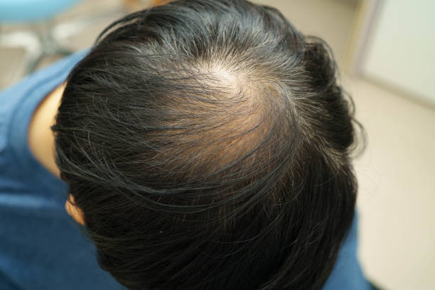 istock Bald head in man, hair loss treatment health problem. 2195607092