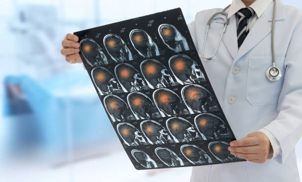 istock Doctor radiology or radiographer looking stroke brain x-ray image for diagnose ischemic stroke or cerebrovascular disease at emergency room. 2195619825