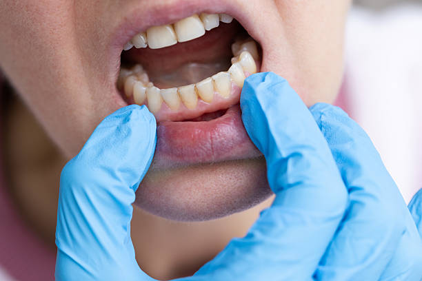 istock Dentist examining teeth with dental calculus and plaque. 2195655646
